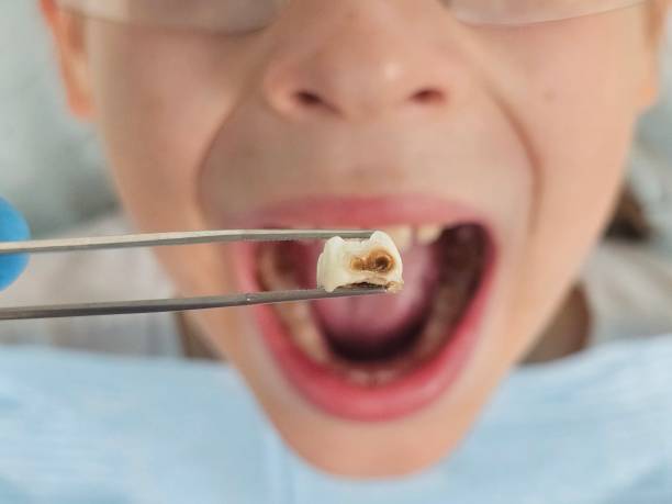 Best Chipped Tooth Repair Near Me  in Pulaski, TN